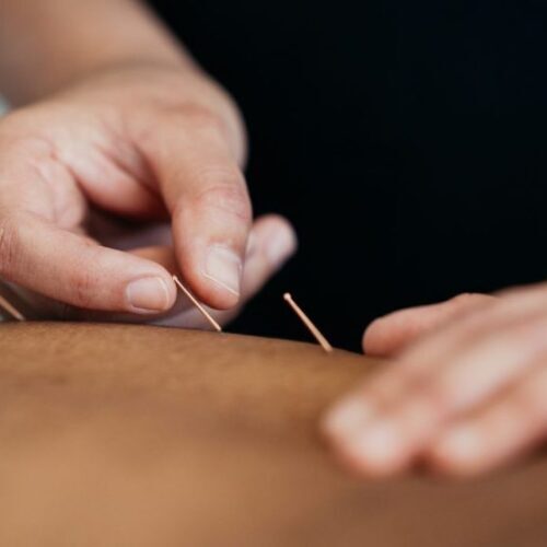 dry-needling-sydney-2-800x560